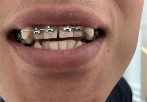 fastbraces reviews|5 months progress on fastbrace : r/braces .